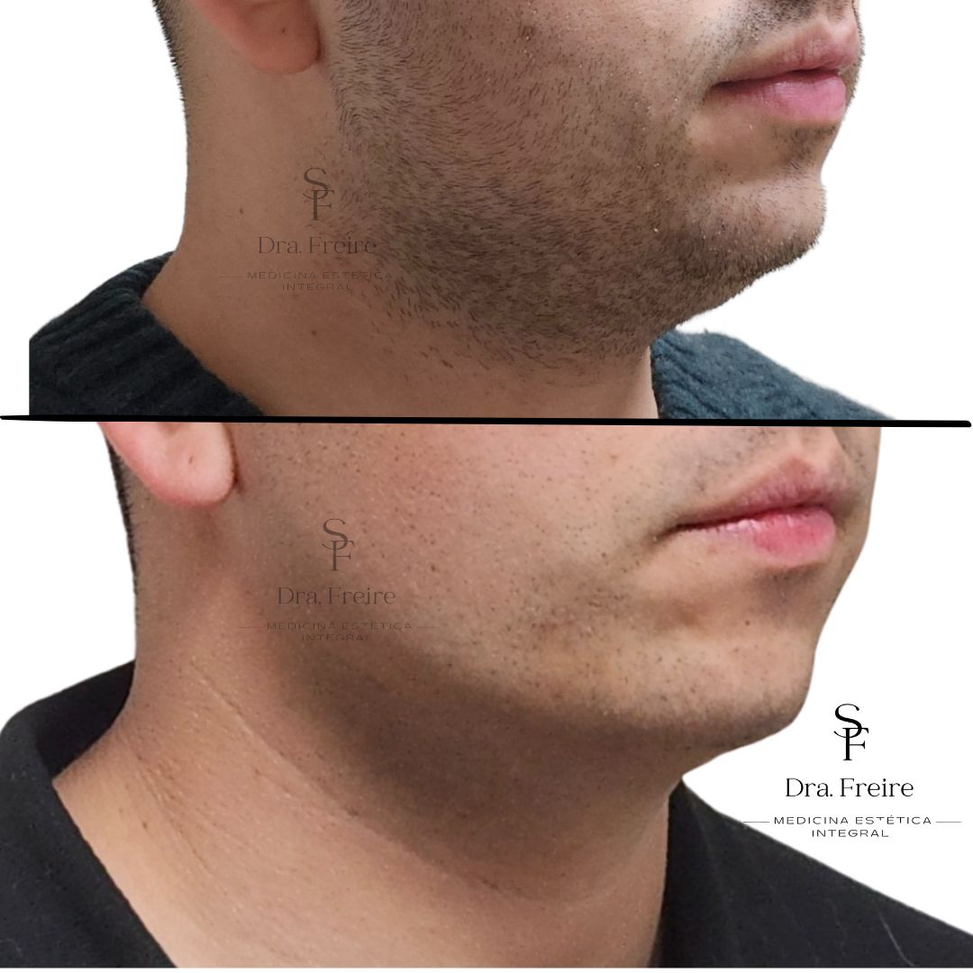 Lipopapada enzimática sin Cirugía