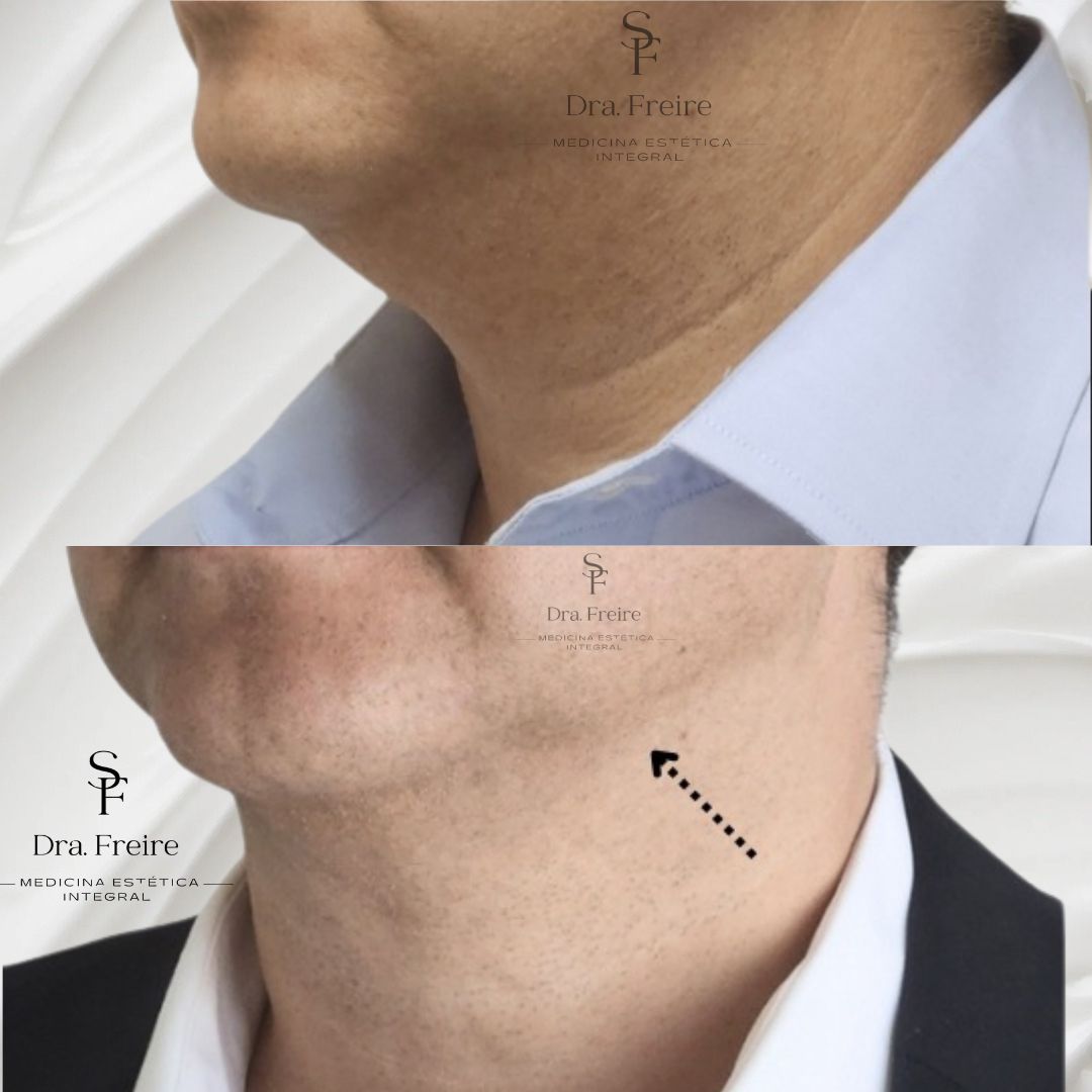 Lipopapada enzimática sin Cirugía