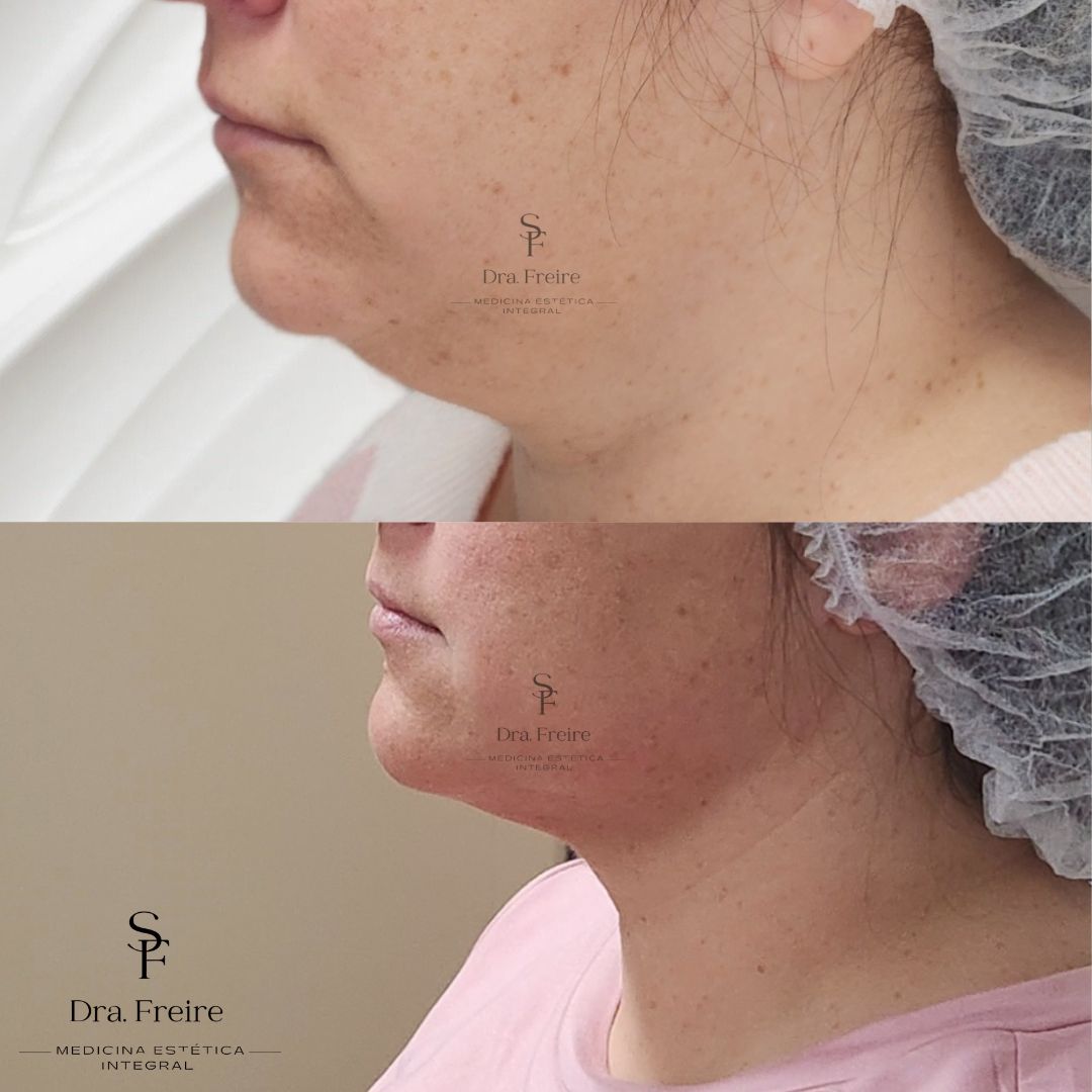 Lipopapada enzimática sin Cirugía