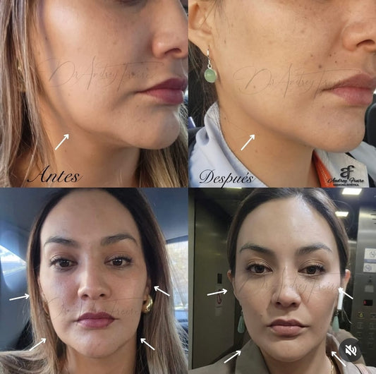 Reduce Flacidez/Bioestimulador de colágeno