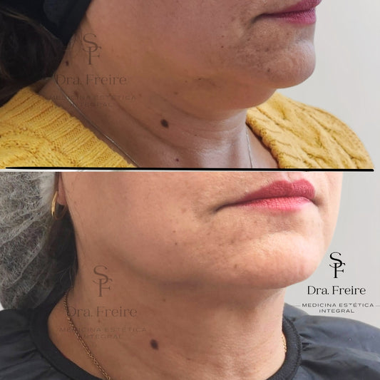 Lipopapada enzimática sin Cirugía