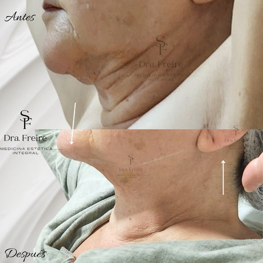 Lifting de Cuello sin Cirugía enzimas + bioestimulador