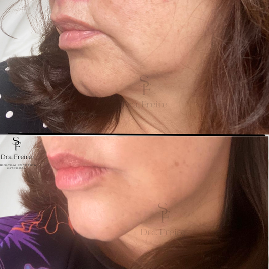 Reduce Flacidez/Bioestimulador de colágeno