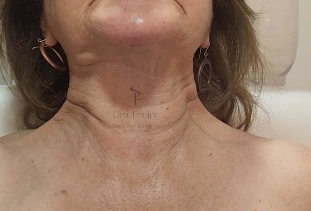 Afinar Cuello sin Cirugía