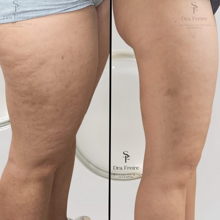 Reducción de celulitis antes y después: mejora de la textura en muslos, paciente de la consulta