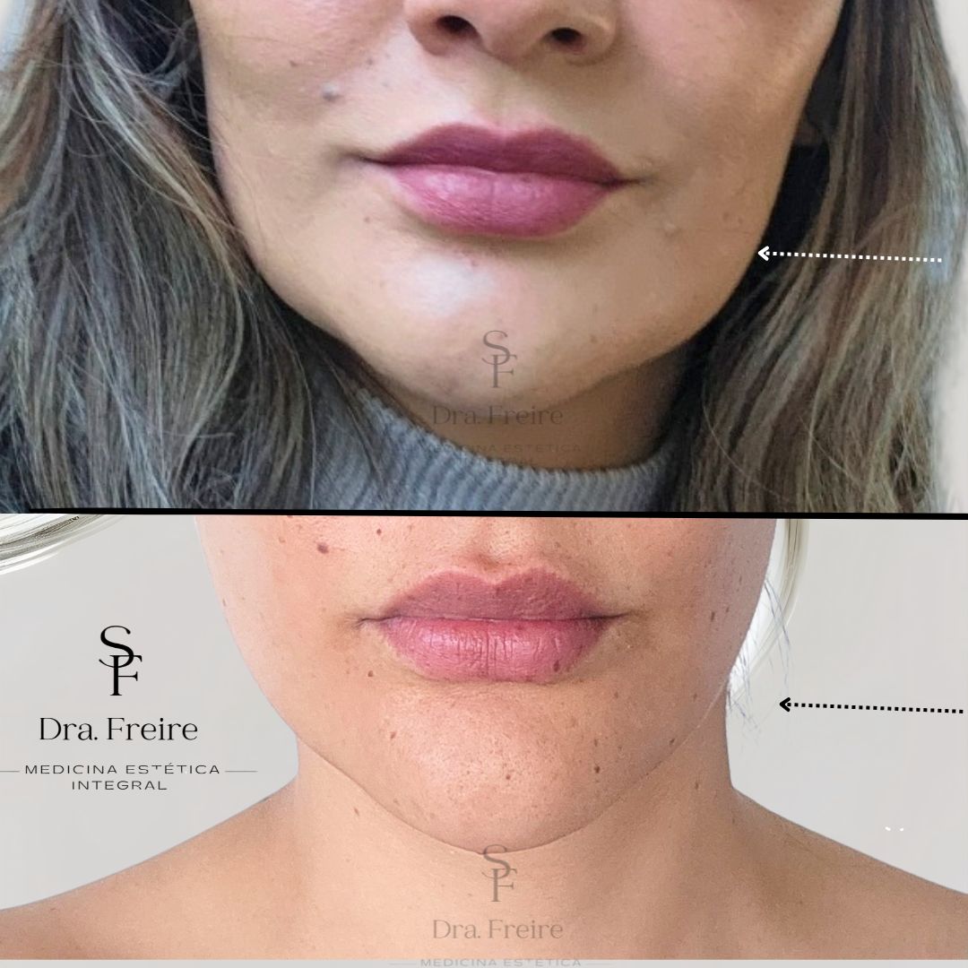 Elimina Bruxismo, Reduce el ancho del rostro