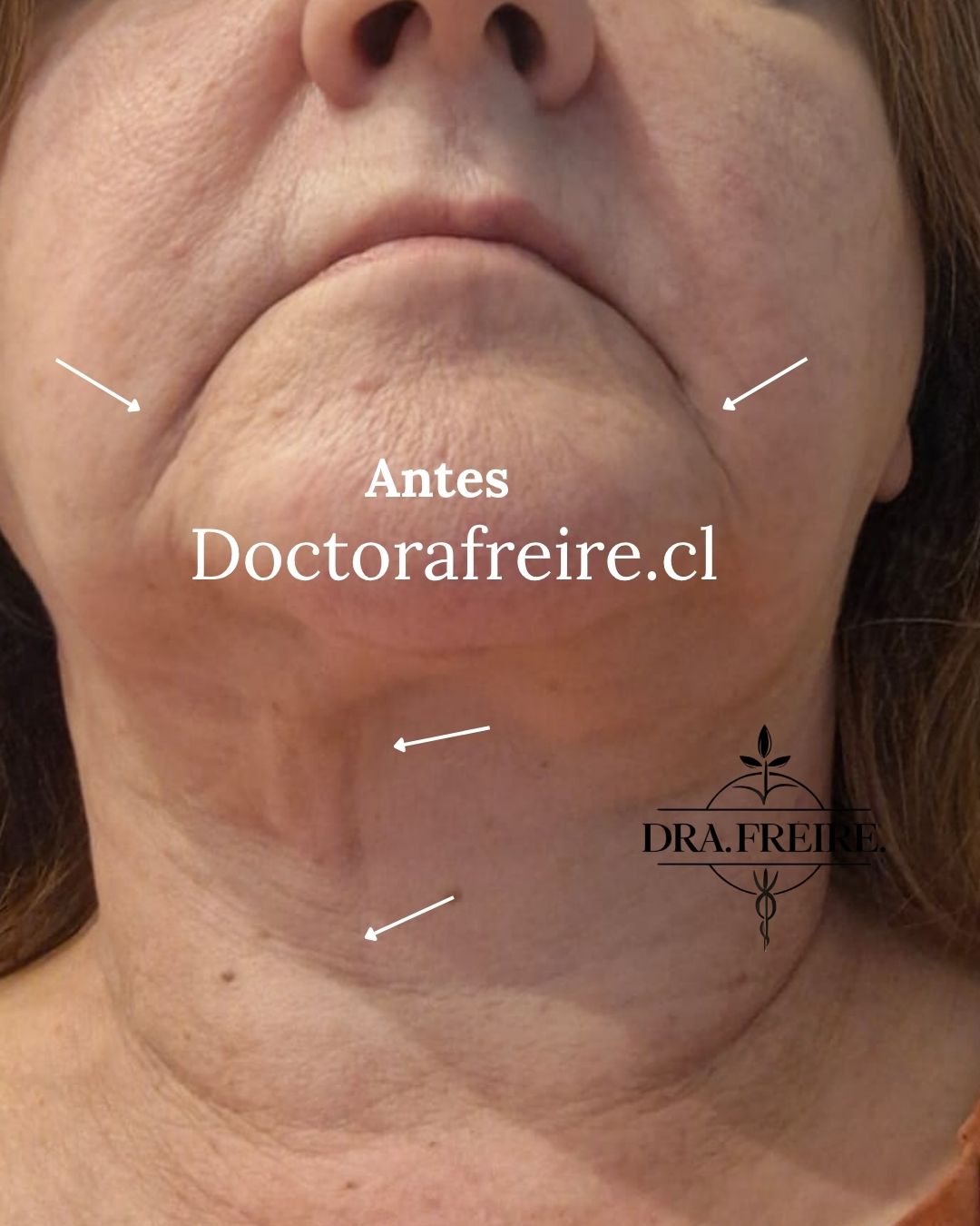 Lipopapada enzimática antes: contorno del cuello y mentón de una paciente de la consulta, Providencia