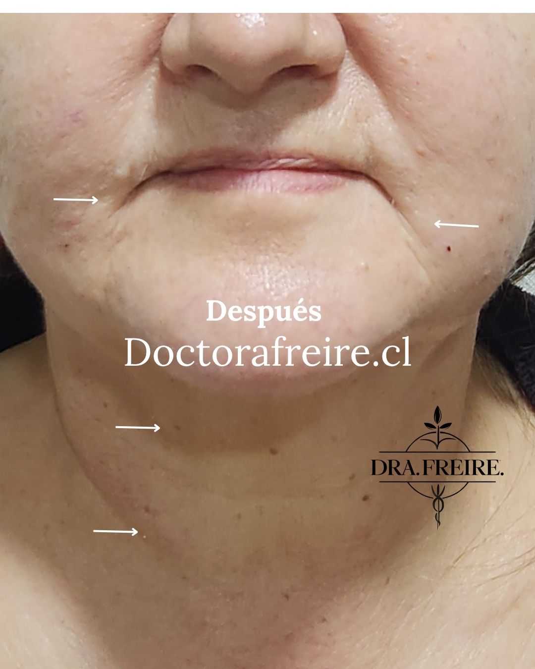 Lipopapada enzimática después: contorno del cuello y mentón definido en la misma paciente