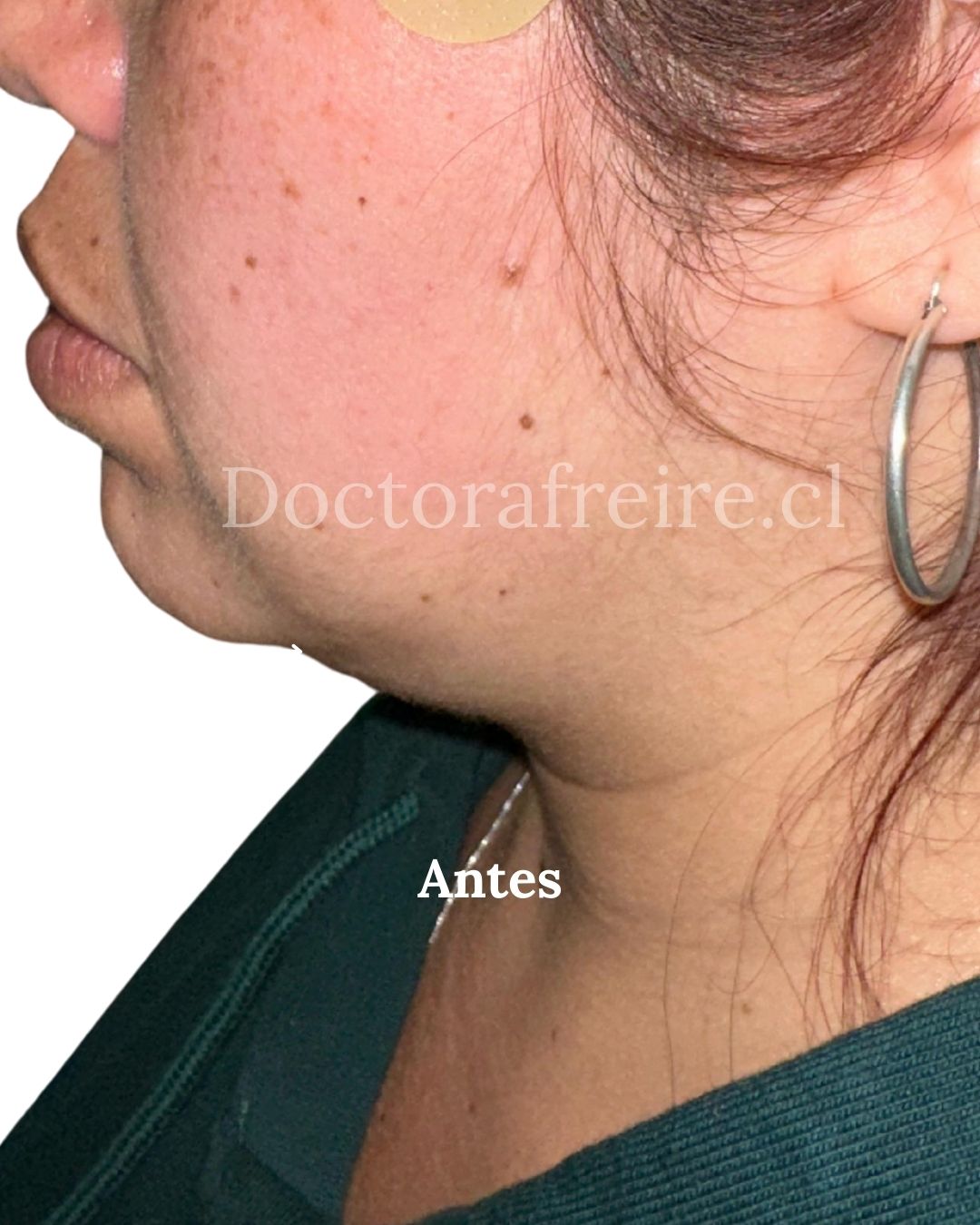 Lipopapada enzimática antes: perfil de una paciente de la consulta con grasa bajo el mentón