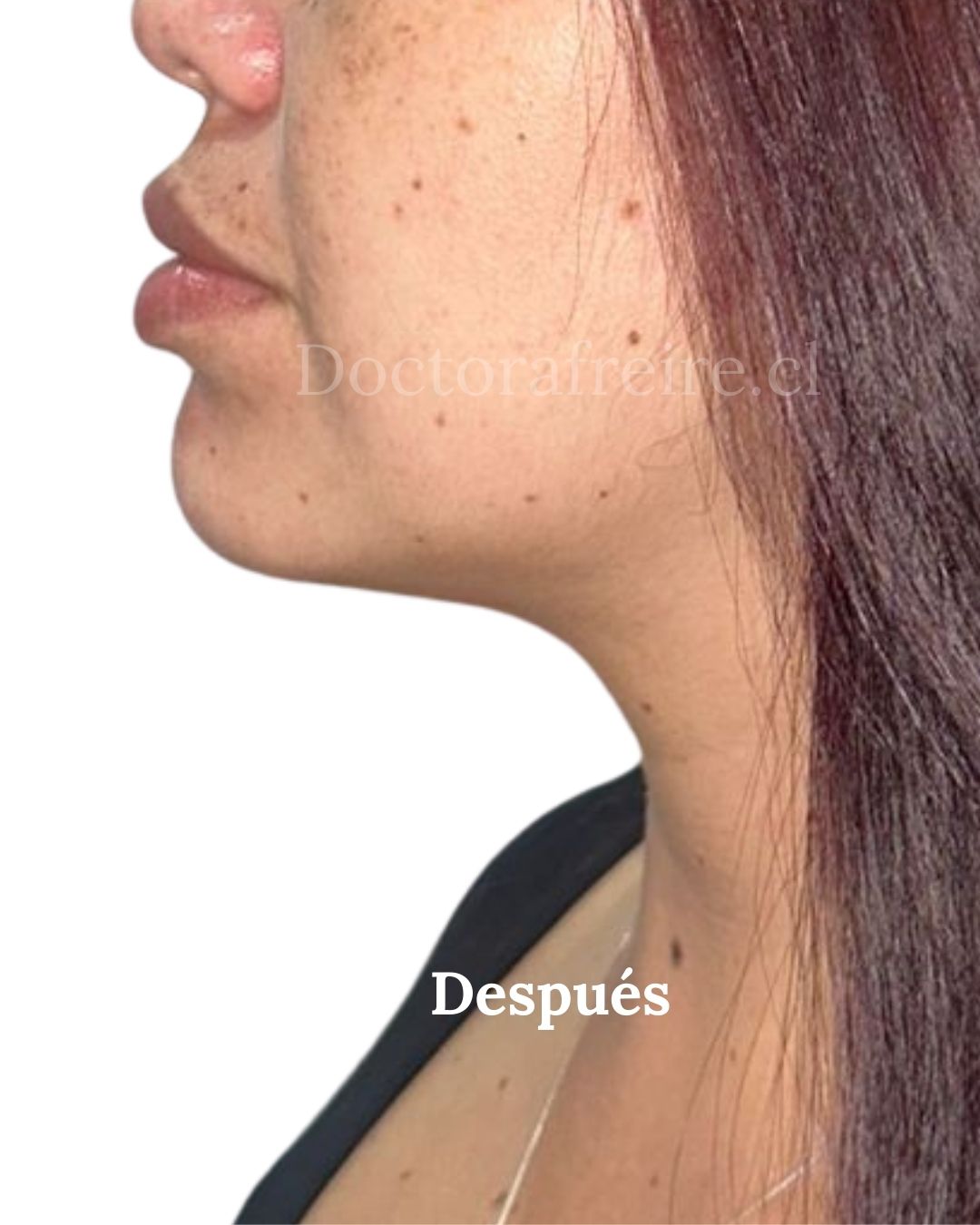 Lipopapada enzimática después: perfil de la misma paciente con el contorno mandibular más marcado